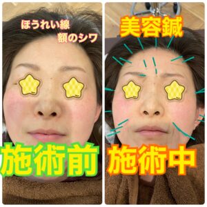 美容鍼の施術