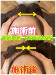 頭部施術の施術